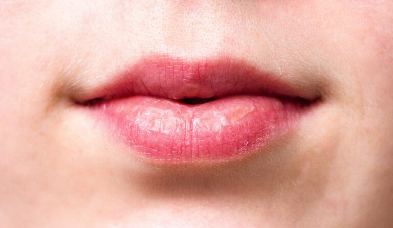 Prosaki na ustach – skąd się biorą, jak się ich pozbyć i jak im zapobiegać?